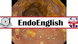 Endoscopic Imaging of C. diffìcile Colitis. МЕДИЦИНСКИЙ АНГЛИЙСКИЙ